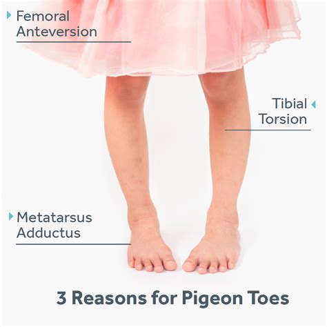 baby pigeon toes treatment.